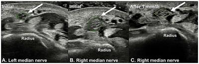 Case report: Traumatic median neuropathy in the distal forearm after <mark class="highlighted">massage therapy</mark>